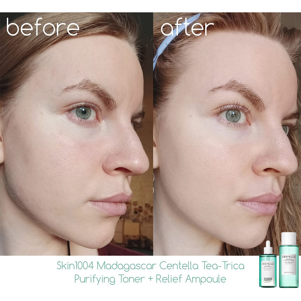 آمپول ضد جوش سنتلا tea trica relief ampoule حجم 100